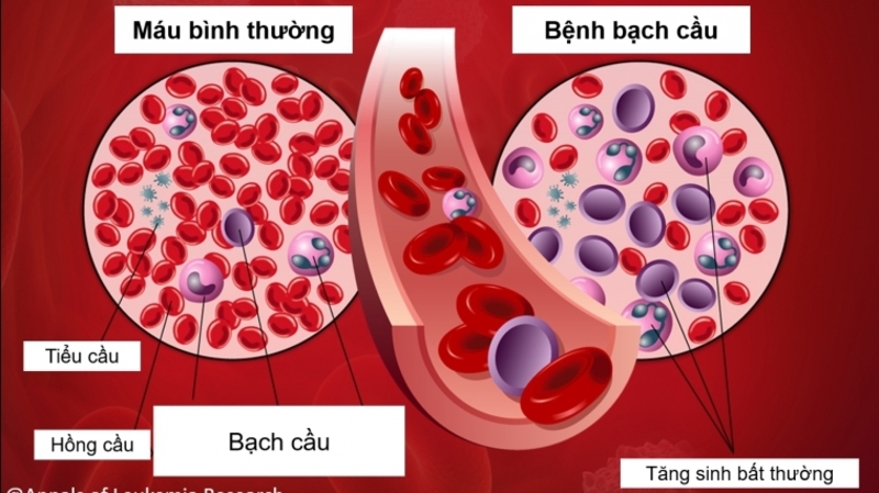 Ung thư máu là nhóm bệnh liên quan đến máu, tủy xương và hệ tạo máu, cần được chẩn đoán chính xác để điều trị phù hợp. 