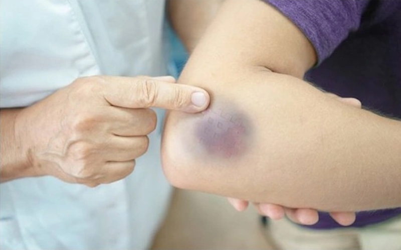 Phát hiện ung thư máu sớm giúp người bệnh có nhiều cơ hội điều trị thuận lợi hơn nếu được theo dõi đúng chuyên khoa. 